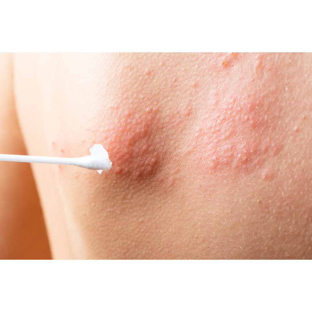 Treatment for shingles: