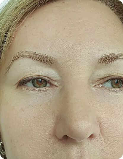 after Filler treatments