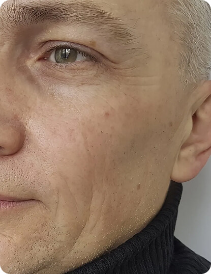 Before Anti-wrinkle treatments