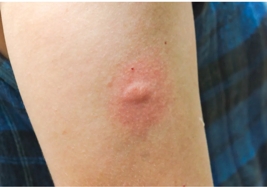 Infected Insect Bites – Pharmacy First