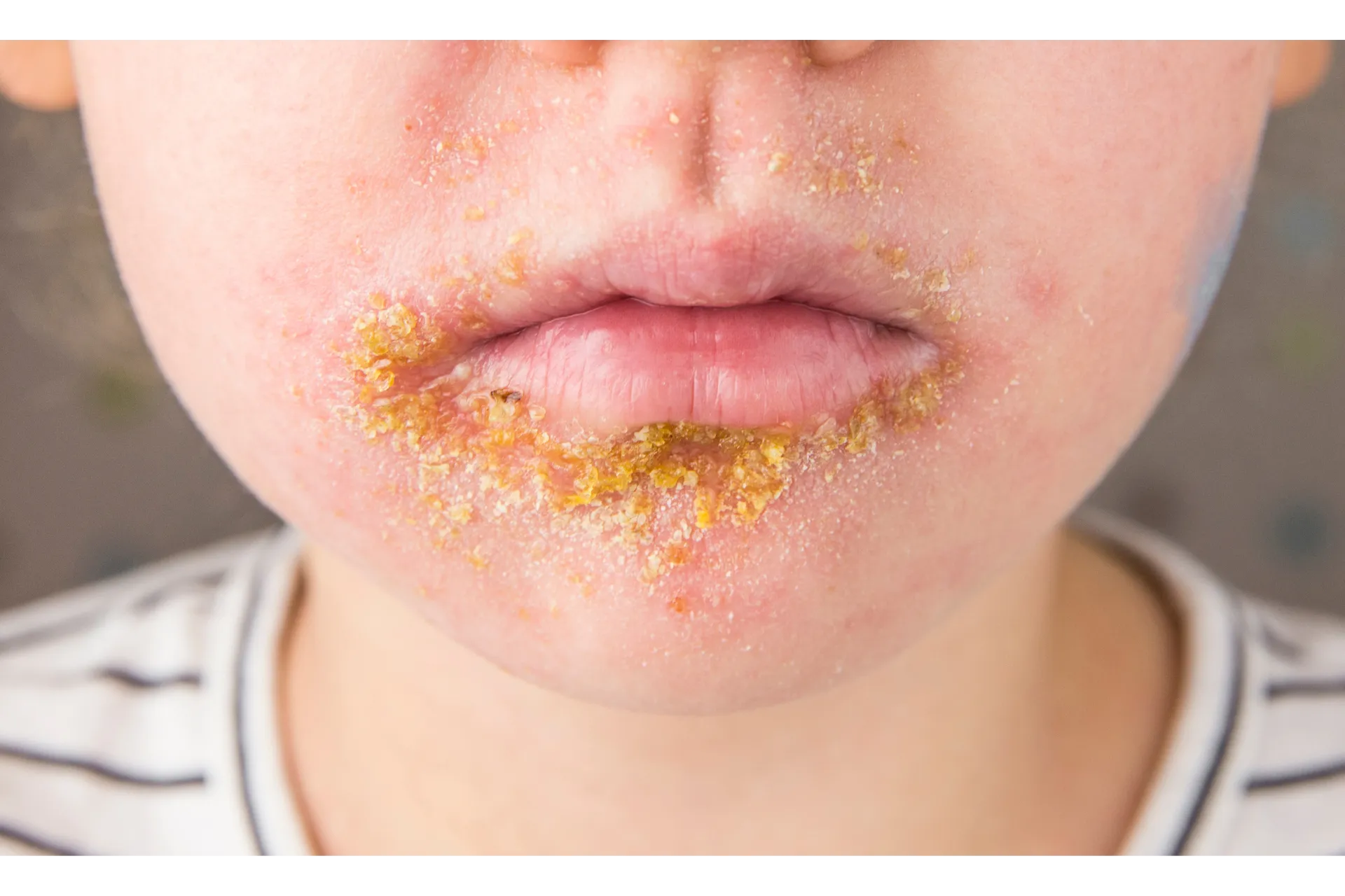 Pharmacy first – Impetigo Pharmacy first – Impetigo
