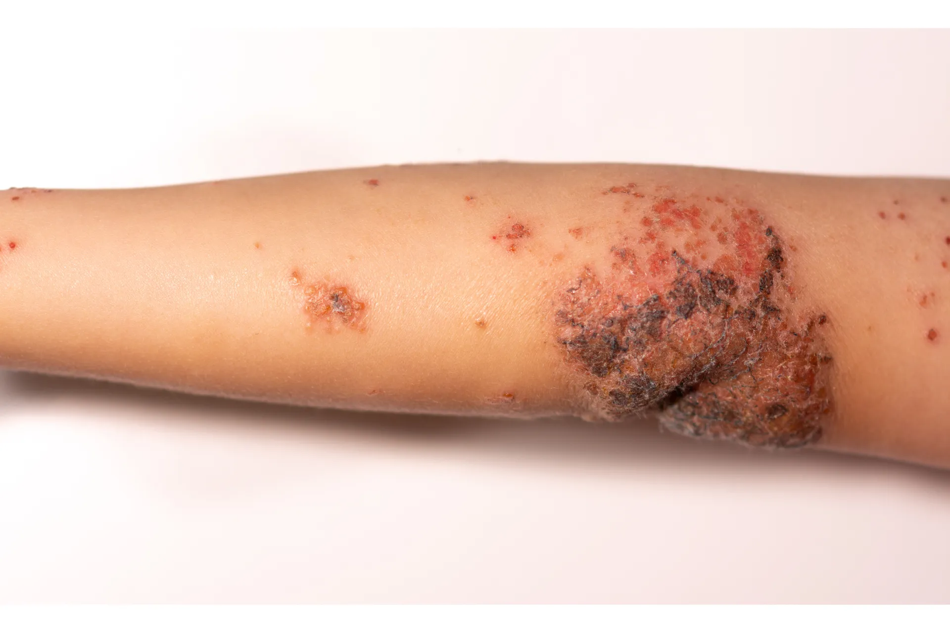The two types of Impetigo The two types of Impetigo